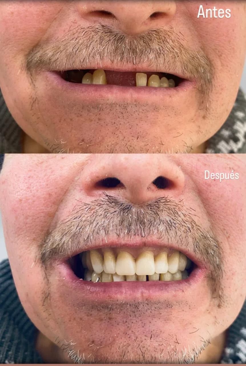 Restauracion Dental